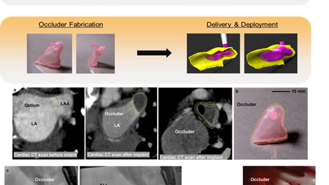 (Top) Patient-specific occluder workflow. Computed tomography (CT); left atrial appendage (LAA) geometry segmented. Inflatable occluder made via 3D printer and deployed in LAA. (Bot.) Patient-specific occluder in animal model. (a-c) Pre-procedure CT of LA