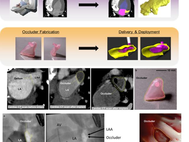 (Top) Patient-specific occluder workflow. Computed tomography (CT); left atrial appendage (LAA) geometry segmented. Inflatable occluder made via 3D printer and deployed in LAA. (Bot.) Patient-specific occluder in animal model. (a-c) Pre-procedure CT of LA