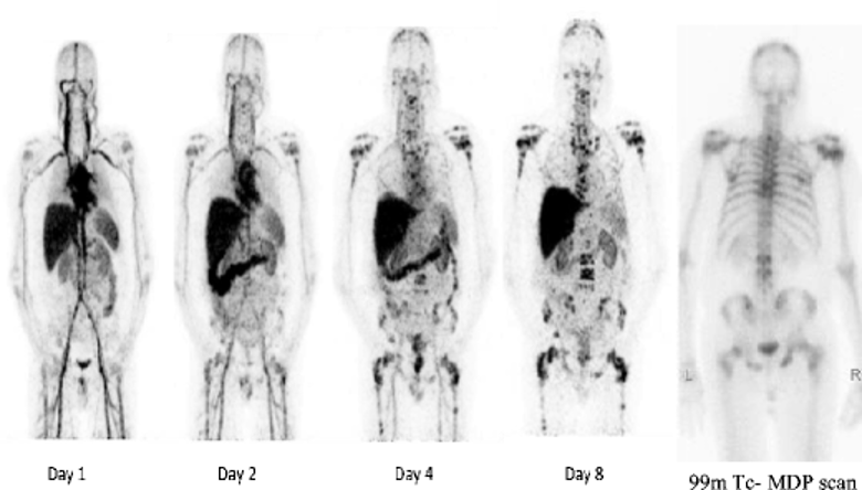 imaging in patients with advanced metastatic prostate cancer.