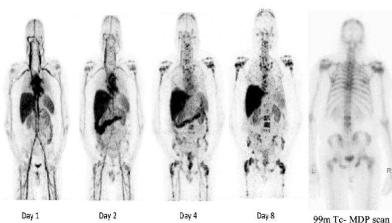 imaging in patients with advanced metastatic prostate cancer. 